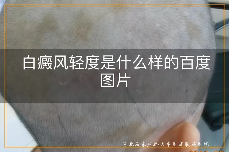 轻度白癜风白斑照片,  
早期白斑初期症状,  
白癜风早期皮损表现