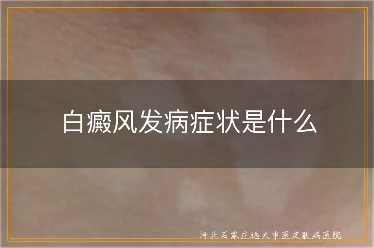 白癜风发病症状是什么