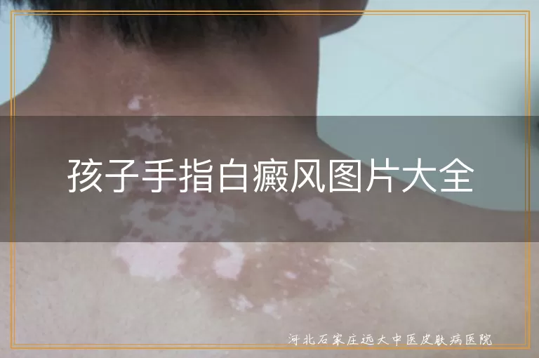 小儿手指白斑相册,白癜风手指图集分享,儿童指端白斑实拍参考