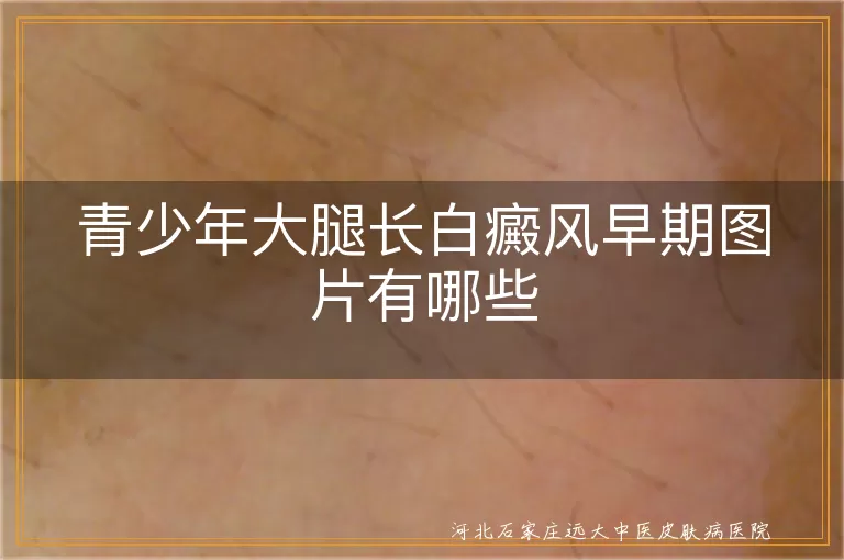青少年大腿长白癜风早期图片有哪些