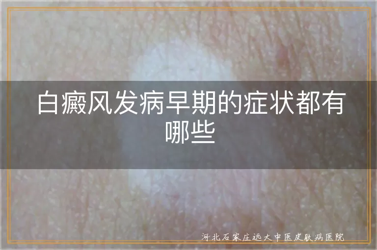 白癜风发病早期的症状都有哪些