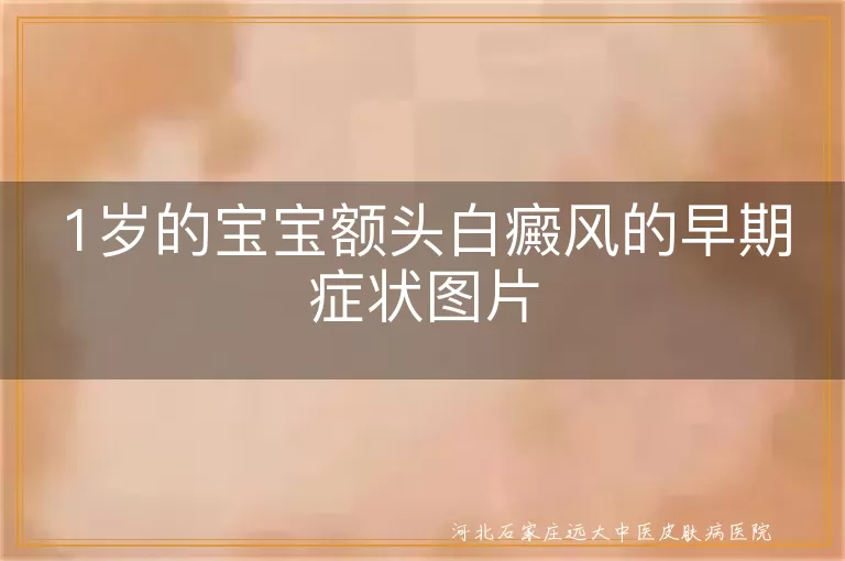 1岁宝宝额头白斑初期表现图,婴儿额头白癜风早期症状,婴幼儿额头白斑照片