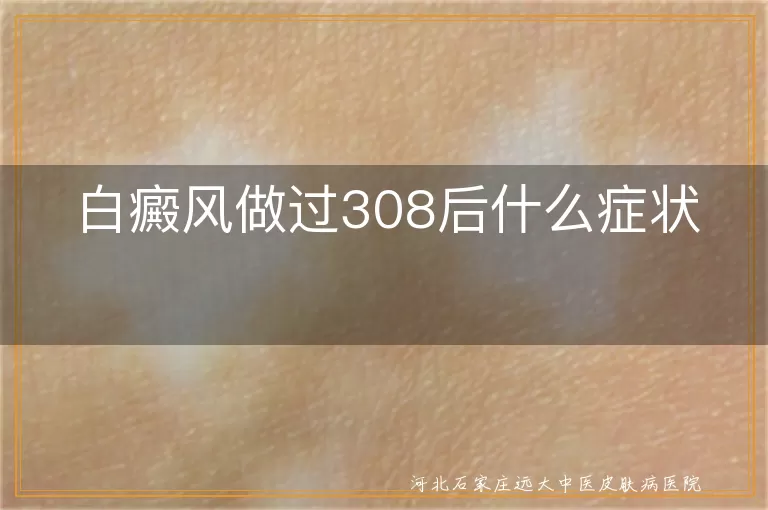 白癜风做过308后什么症状