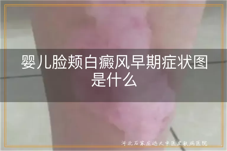 婴儿脸颊白斑初期表现图,宝宝面部白癜风早期迹象,婴幼儿面颊白斑症状参考图