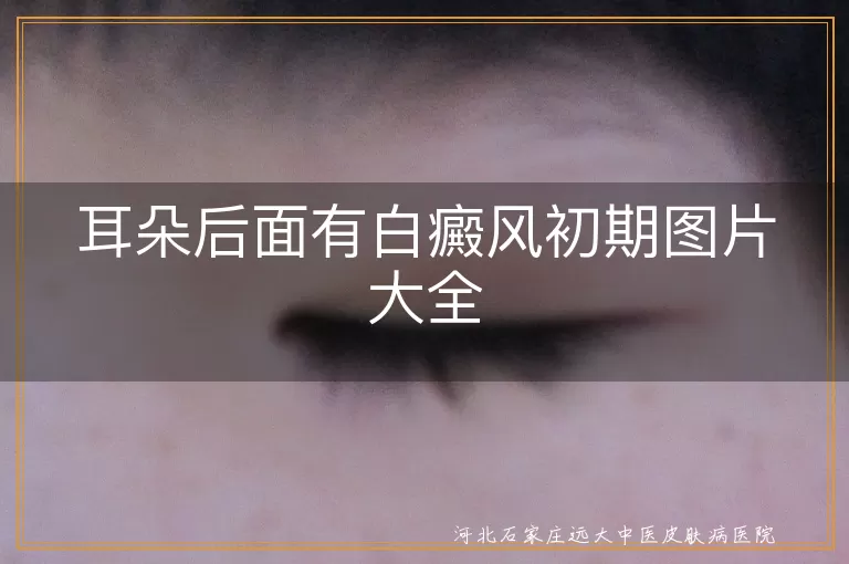 耳朵后白斑真实图,白癜风初期耳后图,耳后白癜风症状图