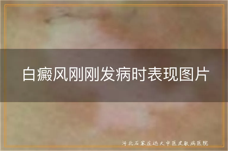白癜风初期白斑图片展示,白癜风刚起时白斑长这样,白斑刚出现时真实照片