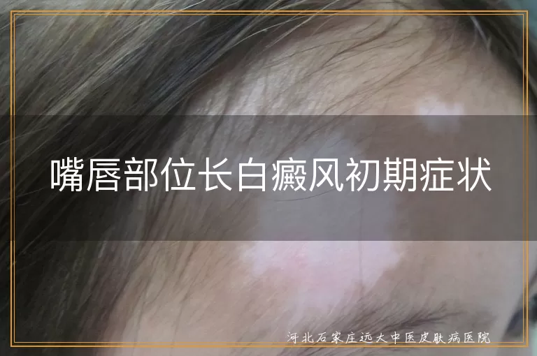 嘴唇白癜风早期表现,白斑初现唇部特征,嘴角白癜风初期迹象