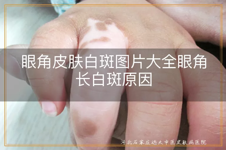 眼角白癜风真实图鉴,眼角白斑成因解析,眼周白癜风症状图库