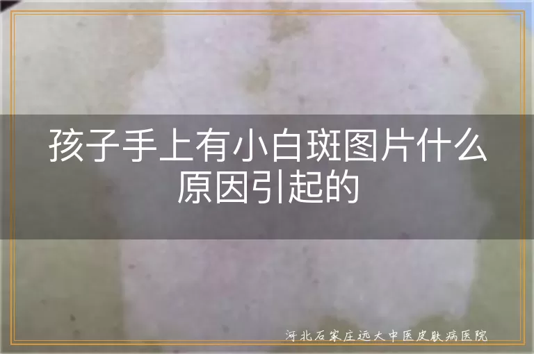 儿童手部白癜风诱因分析,孩子白斑早期图片识别,小白斑是不是白癜风