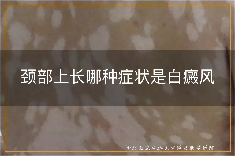 颈部上长哪种症状是白癜风