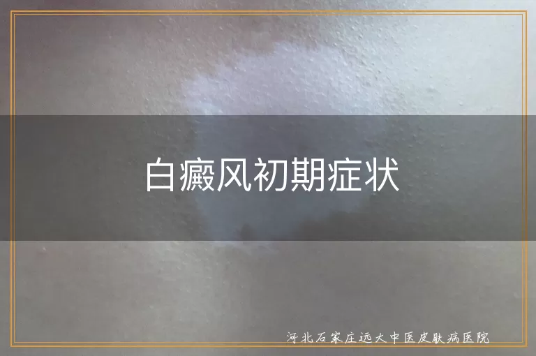白癜风初期症状