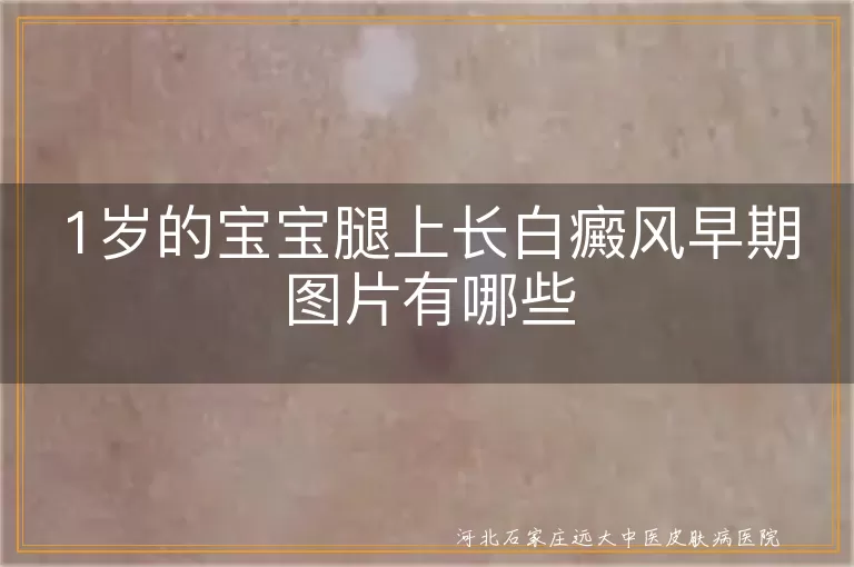1岁的宝宝腿上长白癜风早期图片有哪些