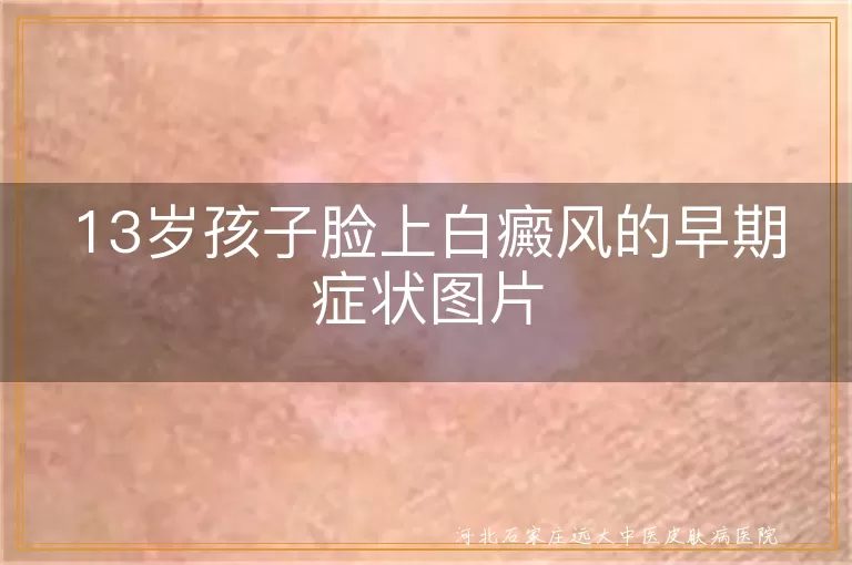 13岁孩子脸上白癜风的早期症状图片