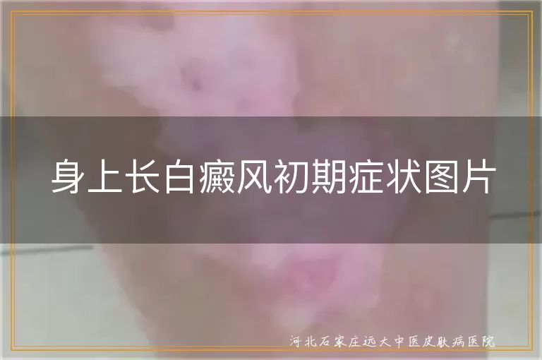 身上长白癜风初期症状图片
