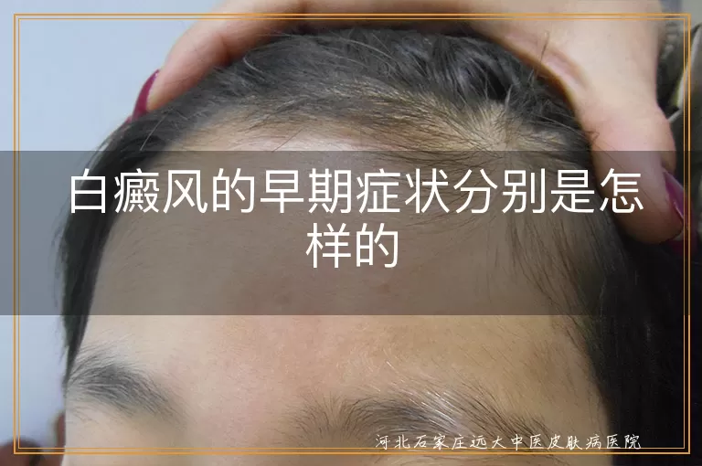 白癜风的早期症状分别是怎样的