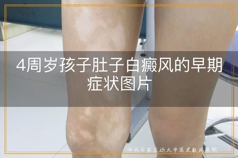 4周岁孩子肚子白癜风的早期症状图片