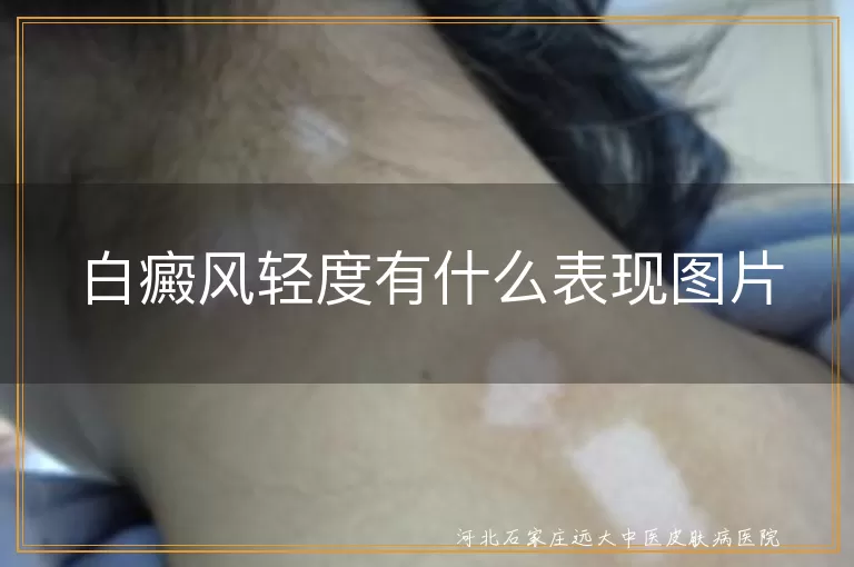 轻度白癜风早期症状图片,早期白斑表现照片,白癜风初期皮损图