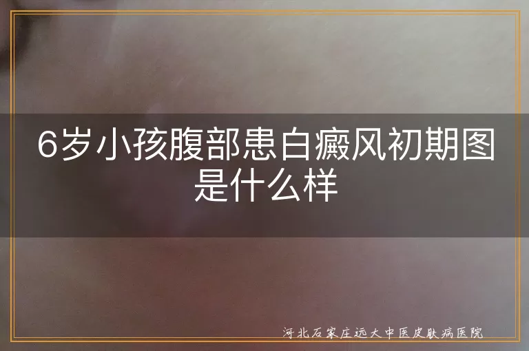 6岁孩子腹部白斑早期症状图,小儿腹部白癜风初期图片表现,儿童腹部白斑白癜风初期照片