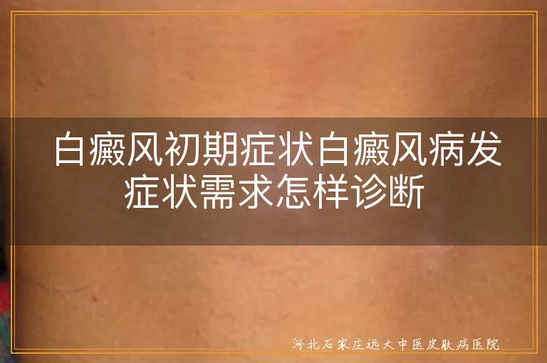 白癜风初期症状白癜风病发症状需求怎样诊断