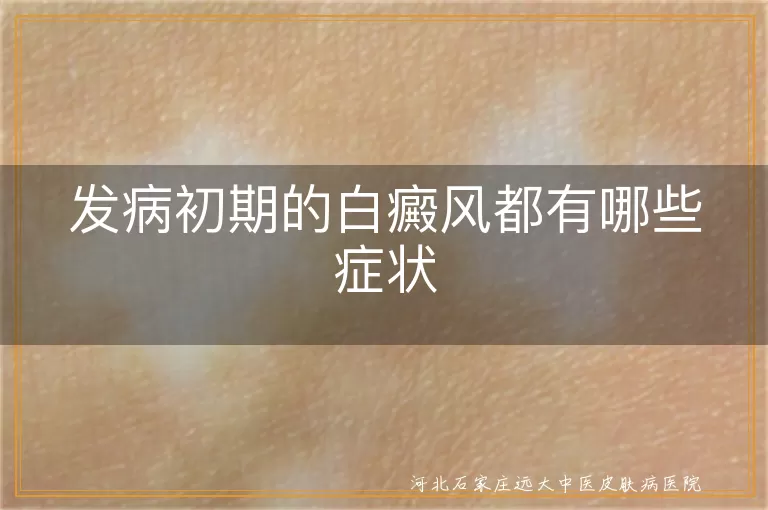 发病初期的白癜风都有哪些症状