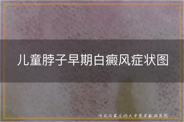 儿童颈部白斑早期症状图,白癜风早期表现图片,儿童白癜风初期照片