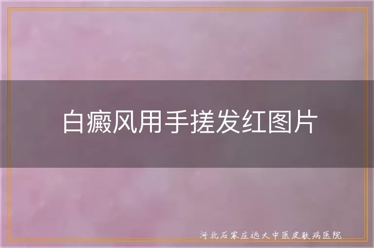 白癜风用手搓发红图片