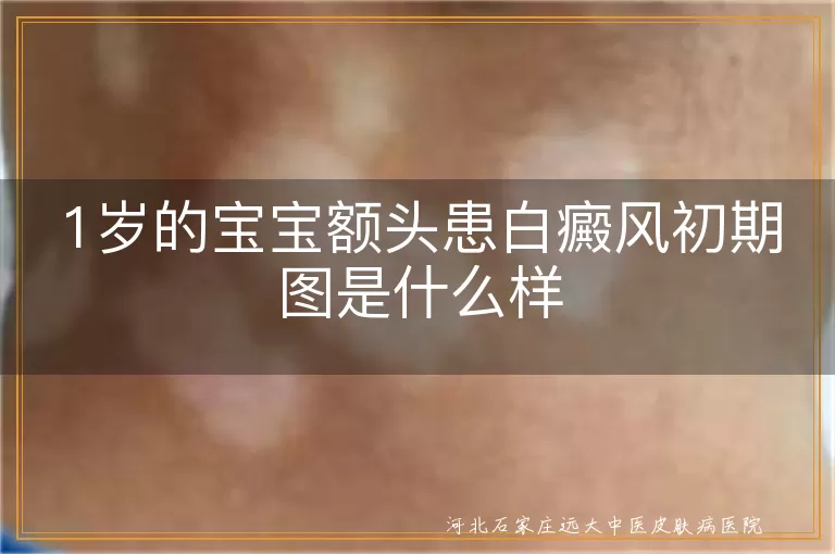 1岁婴儿额头白斑早期症状,宝宝额头白癜风初期表现图,一岁幼儿白癜风白斑初期图片