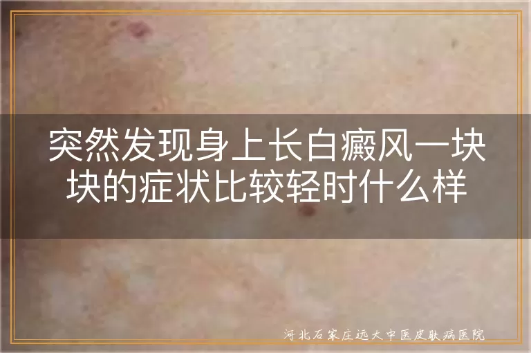 白癜风初期浅色斑块特征,白斑刚出现轻微表现,白癜风早期小块状图片