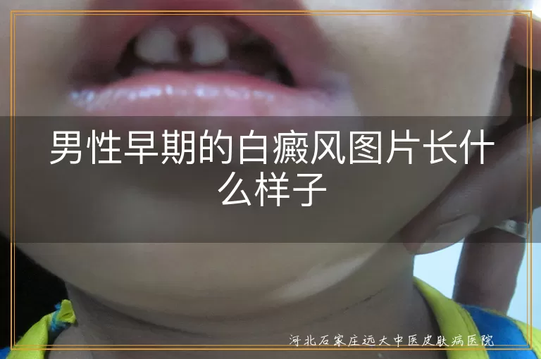 男性早期的白癜风图片长什么样子