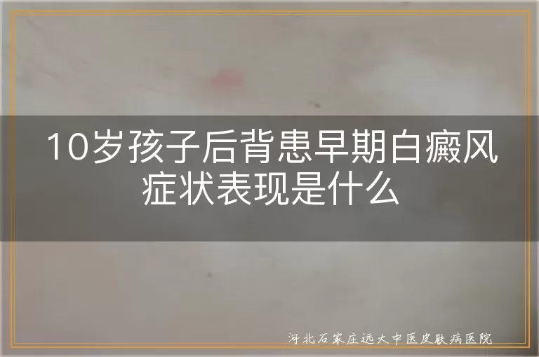 10岁孩子后背患早期白癜风症状表现是什么