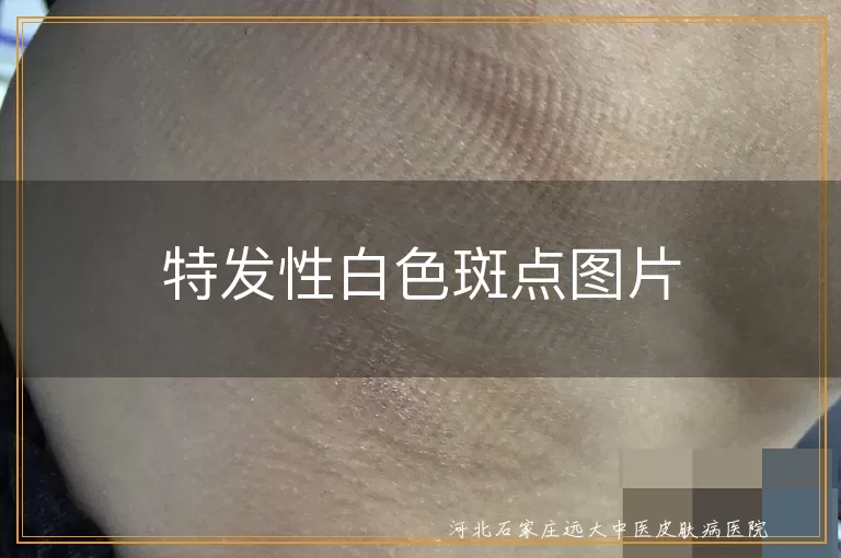 特发性白色斑点图片