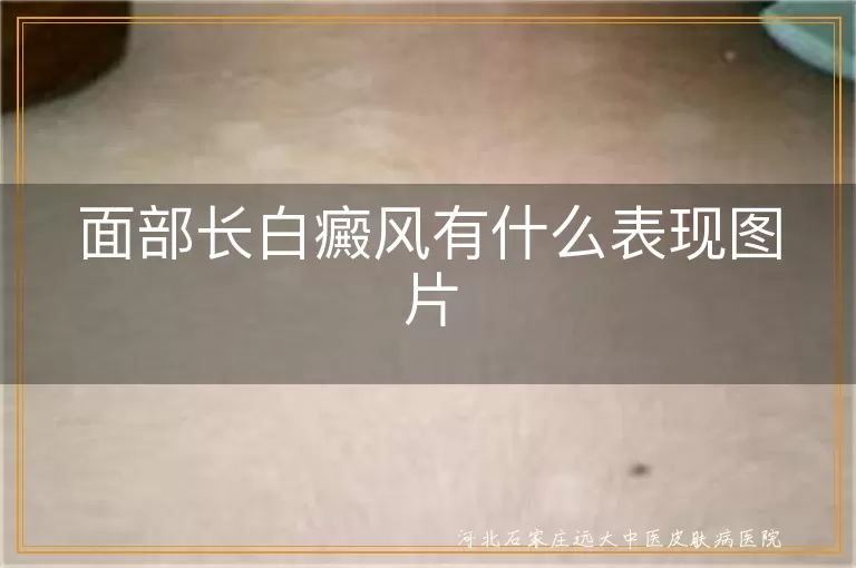 面部白癜风初期白斑图片,脸上长白癜风白斑症状,面部白癜风白斑表现图解