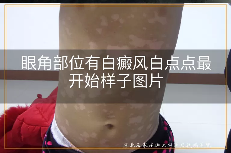 眼角白癜风初期白点照片,眼角白斑早期症状图片,白癜风白点点起始图