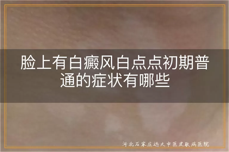 脸上白斑初期症状,白癜风早期白点点,面部白斑常见表现