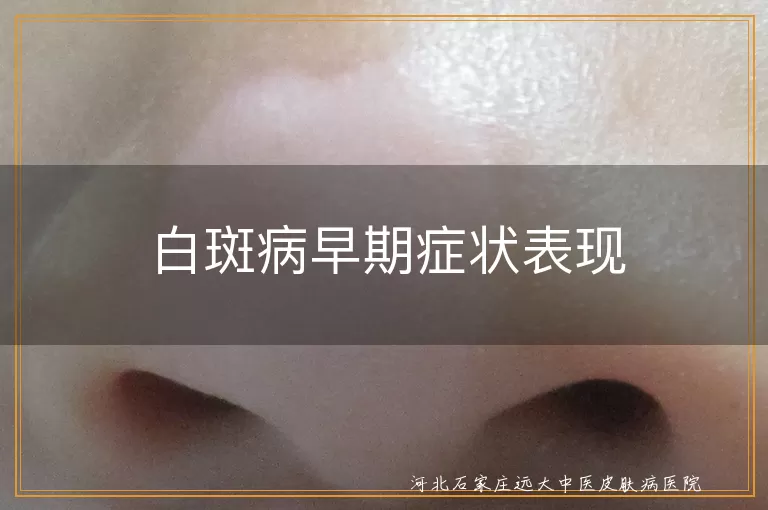 白斑病早期症状表现