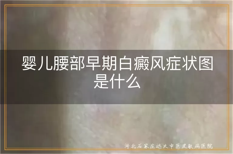 婴儿腰部早期白癜风症状图是什么