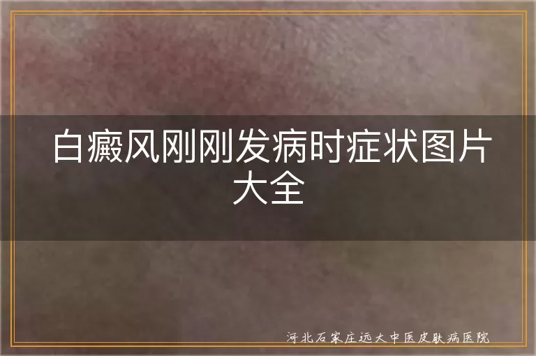 白癜风刚刚发病时症状图片大全