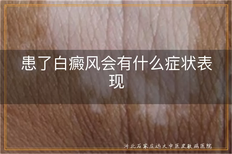 患了白癜风会有什么症状表现