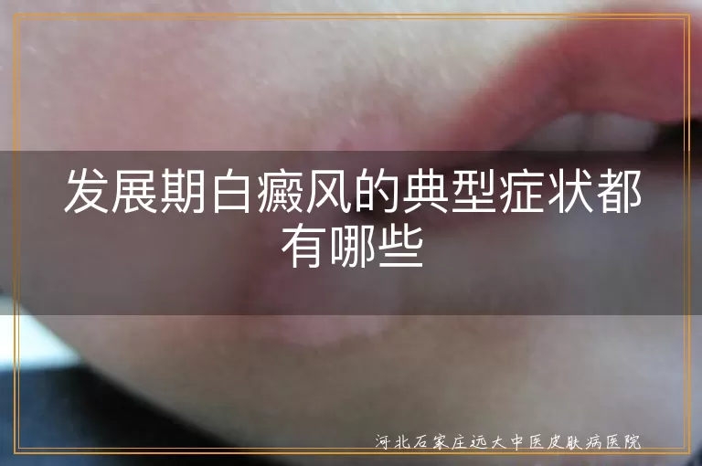发展期白癜风的典型症状都有哪些