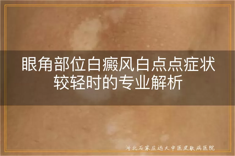 眼角部位白癜风白点点症状较轻时的专业解析