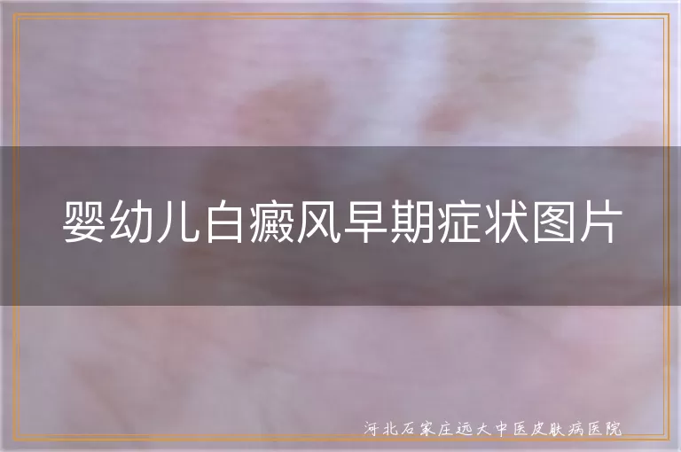 婴幼儿白癜风早期症状图片