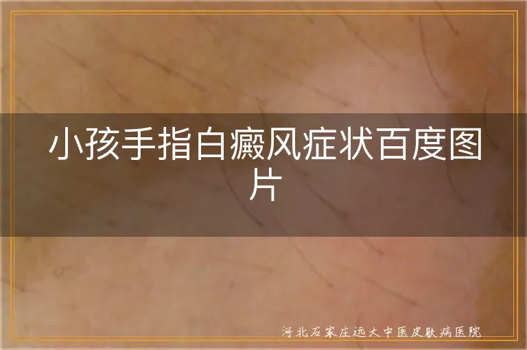 儿童手指白斑症状图,小儿指端白癜风图片,婴幼儿手部白斑照片