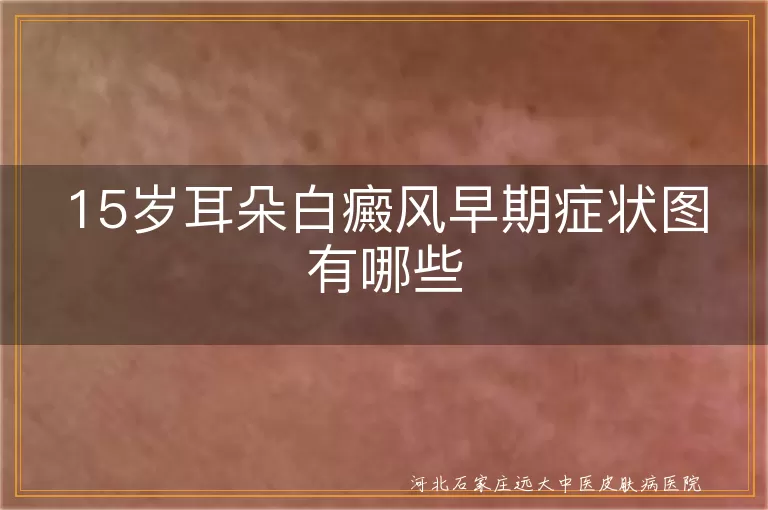 15岁耳朵白癜风早期症状图有哪些
