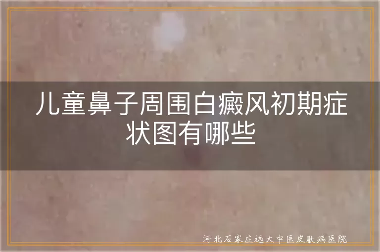 儿童鼻子周围白癜风初期症状图有哪些