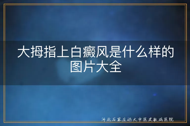 大拇指白癜风早期症状图片,手指白斑是什么样子的,拇指皮肤出现白斑图片