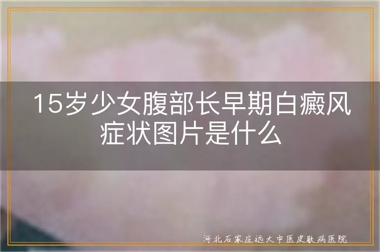 15岁少女腹部长早期白癜风症状图片是什么