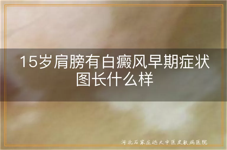 15岁青少年肩膀白斑初期症状,肩膀白癜风早期图片特征,青少年肩部白斑识别方法