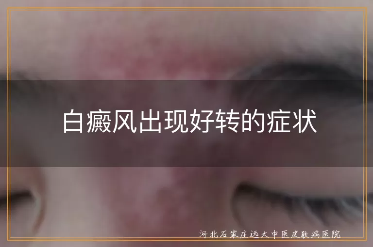 白癜风出现好转的症状