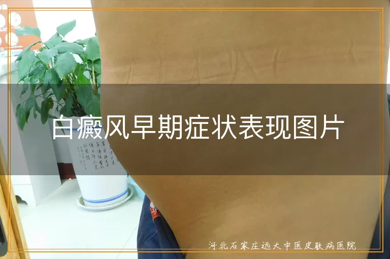 `白癜风早期症状表现图片识别要点,皮肤白斑初期特征对比分析,白癜风皮损形态演变过程图`