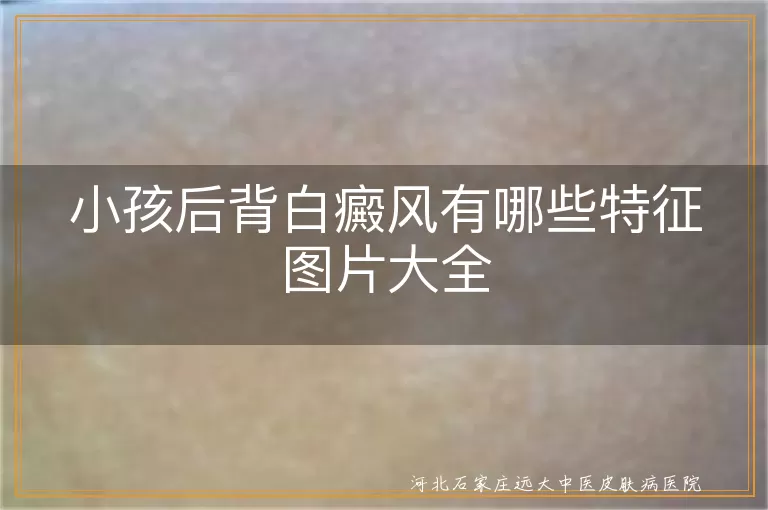小孩后背白癜风有哪些特征图片大全